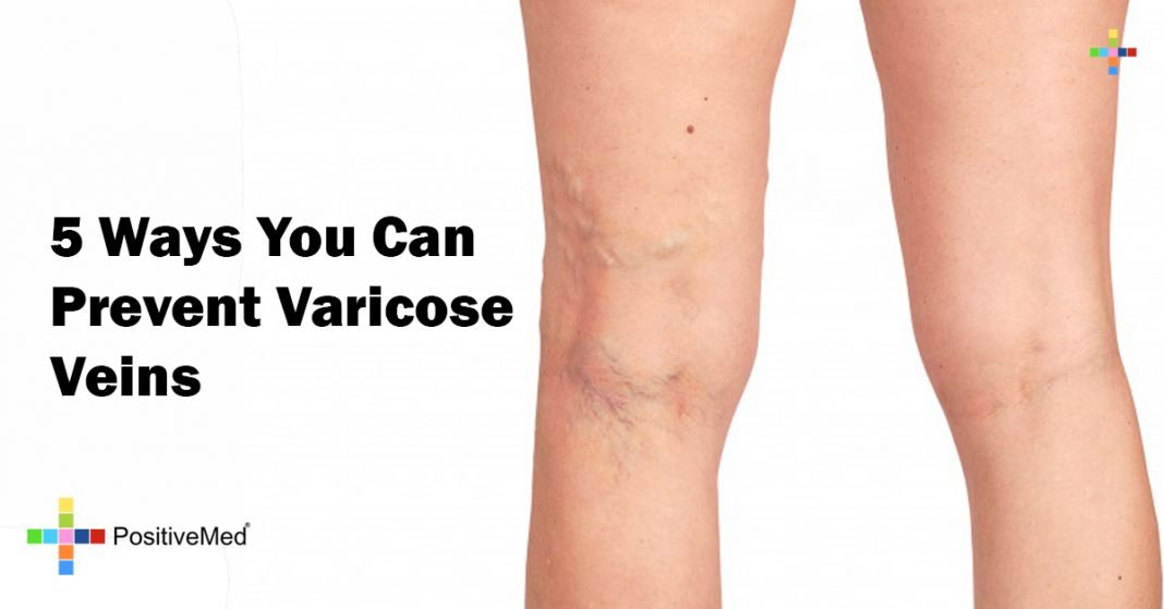 5 Ways You Can Prevent Varicose Veins PositiveMed