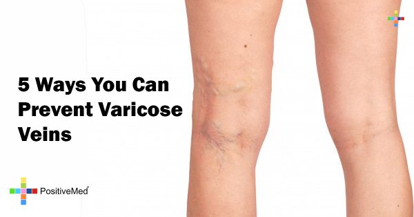 5 Ways You Can Prevent Varicose Veins PositiveMed