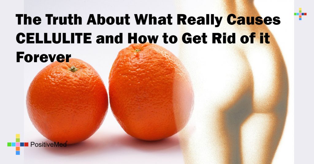 The Truth About What Really Causes CELLULITE and How to Get Rid of it Forever