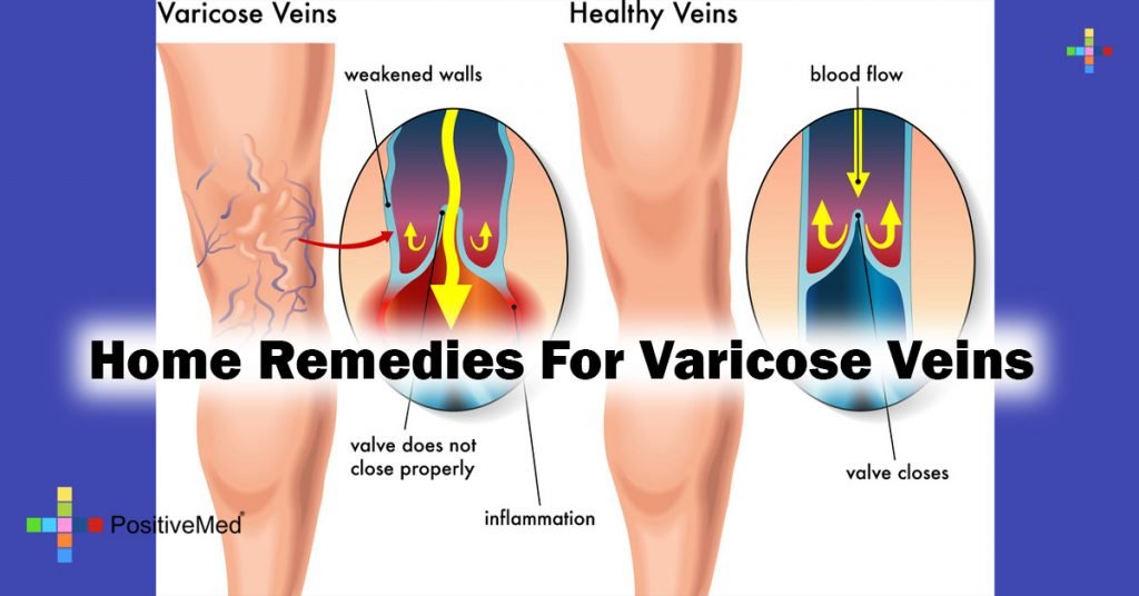Home Remedies For Varicose Veins