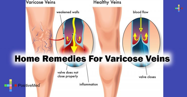 Home Remedies For Varicose Veins Home Remedies For Varicose Veins