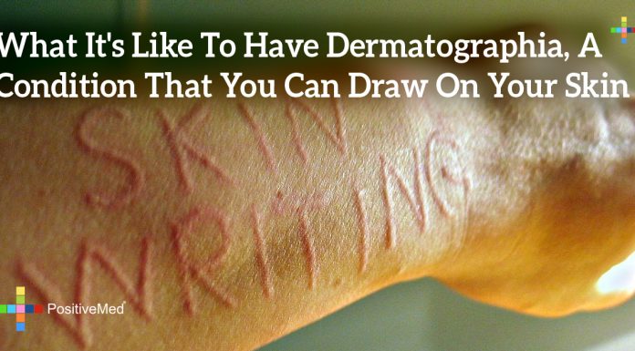 What It's Like To Have Dermatographia, A Condition That You Can Draw On Your Skin