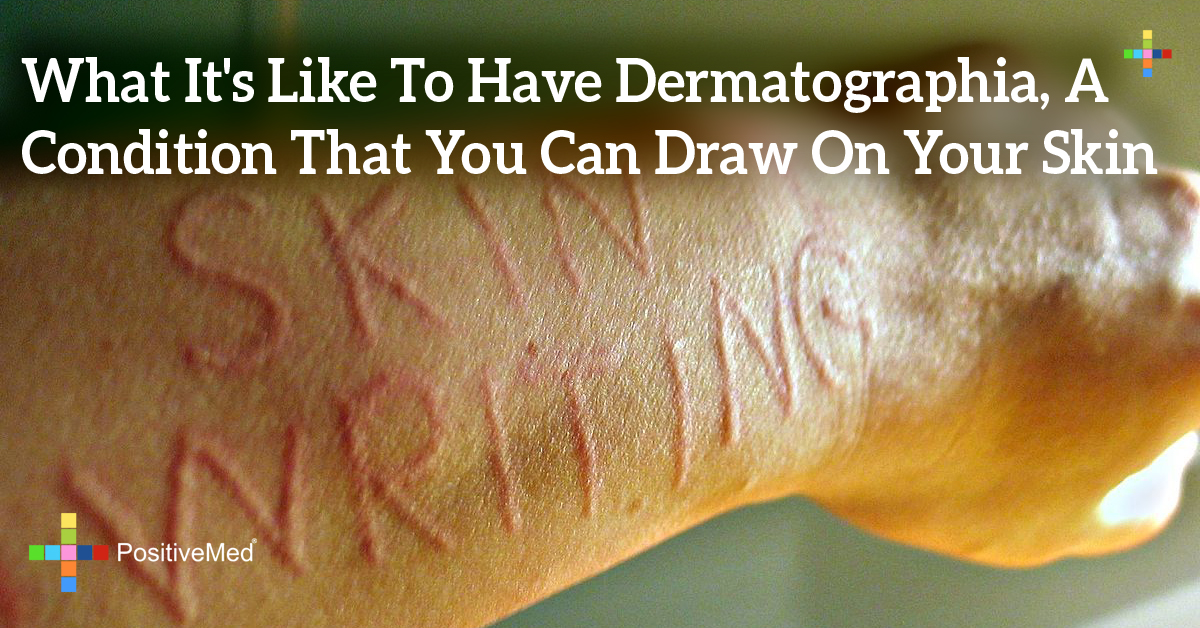 What It's Like To Have Dermatographia, A Condition That You Can Draw On Your Skin