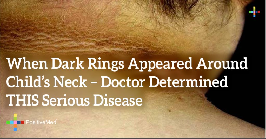 When Dark Rings Appeared Around Child's Neck - Doctor Determined THIS Serious Disease