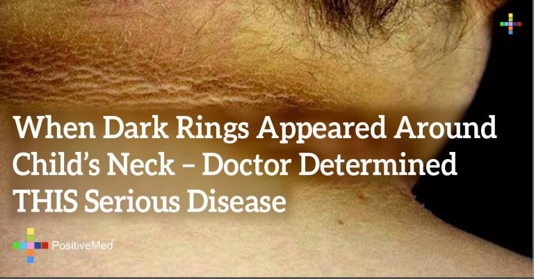 When Dark Rings Appeared Around Child’s Neck – Doctor Determined THIS Serious Disease
