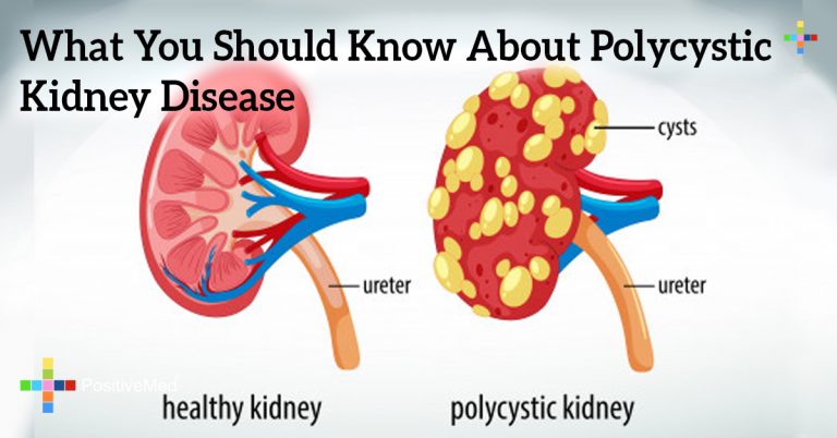 What You Should Know About Polycystic Kidney Disease What You Should Know About Polycystic Kidney Disease