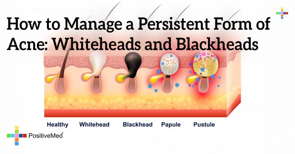 How to Manage a Persistent Form of Acne: Whiteheads and Blackheads