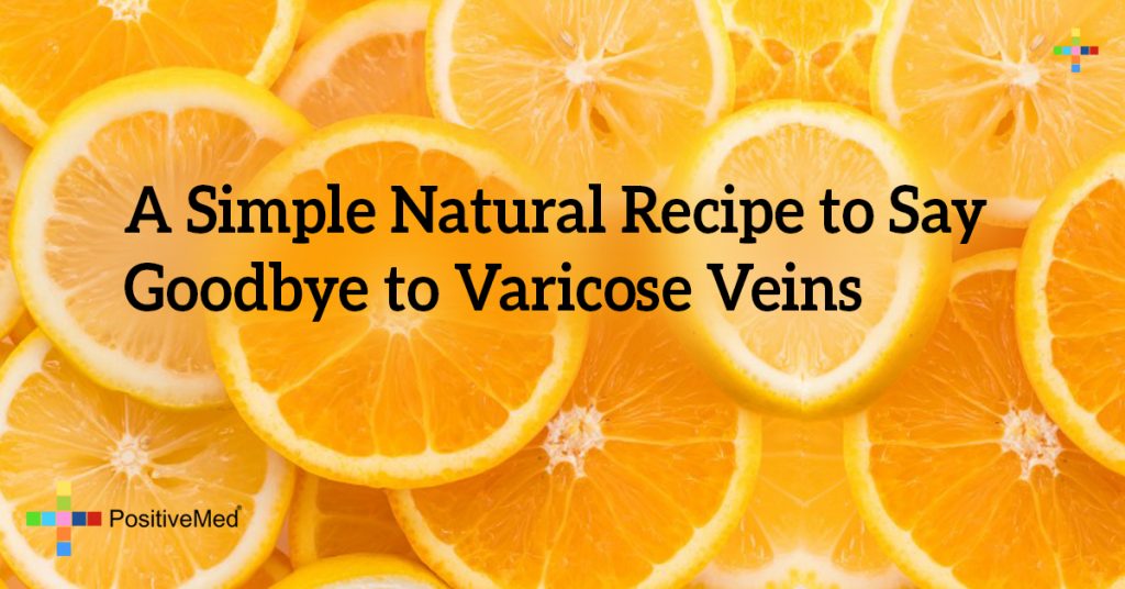 A Simple Natural Recipe to Say Goodbye to Varicose Veins