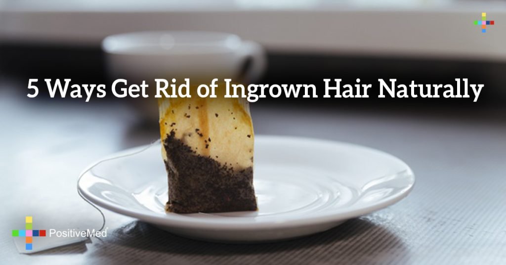 5 Ways Get Rid of Ingrown Hair Naturally
