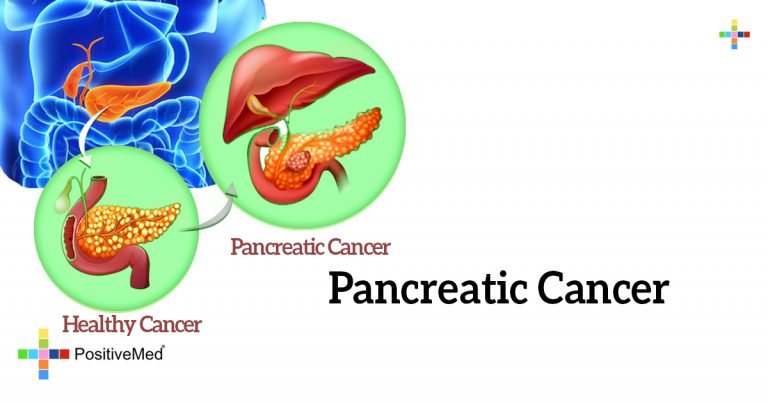 Pancreatic Cancer Pancreatic Cancer