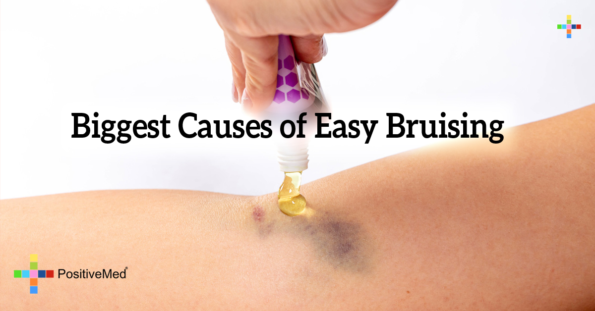 Top Reasons You Bruise Easily