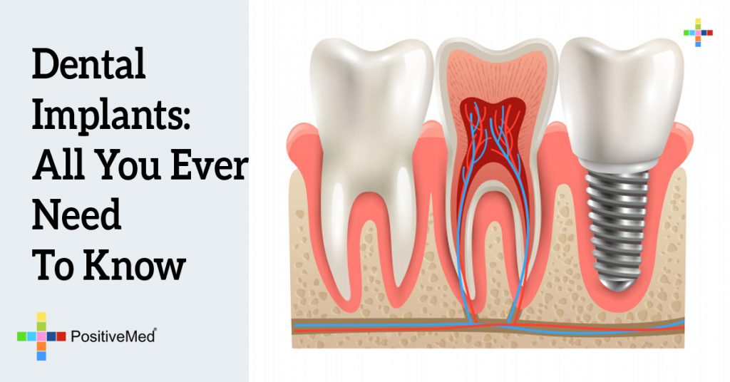 Dental Implants: All You Ever Need To Know