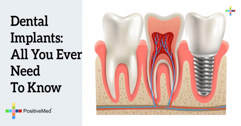 Dental Implants: All You Ever Need To Know Dental Implants: All You Ever Need To Know
