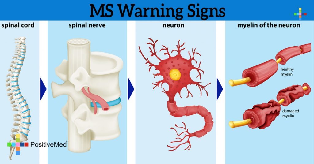 MS Warning Signs