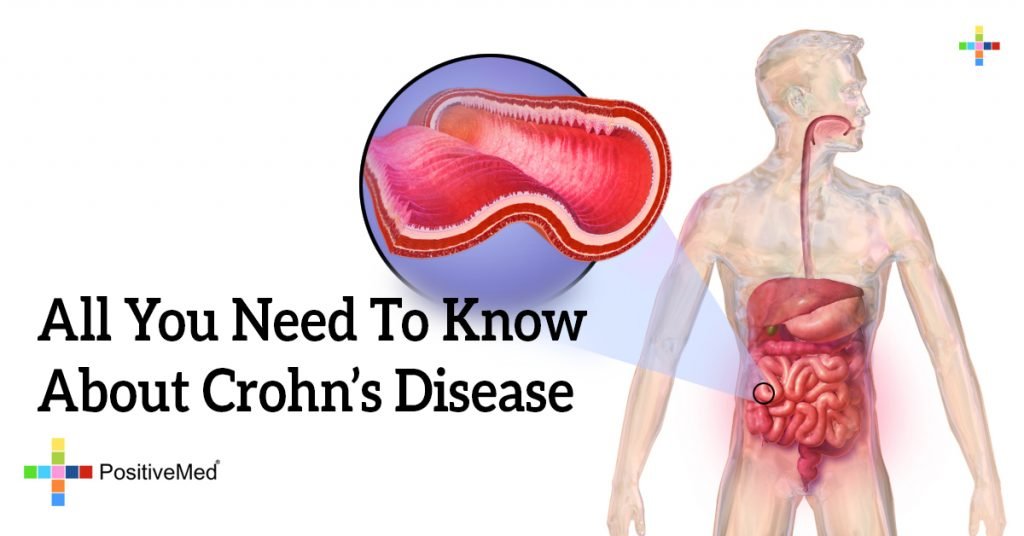 All You Need To Know About Crohn's Disease 