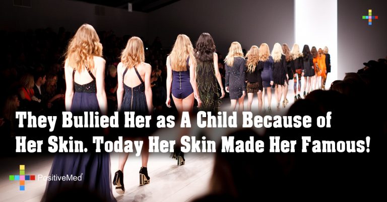 They Bullied Her as A Child Because of Her Skin. Today Her Skin Made Her Famous!