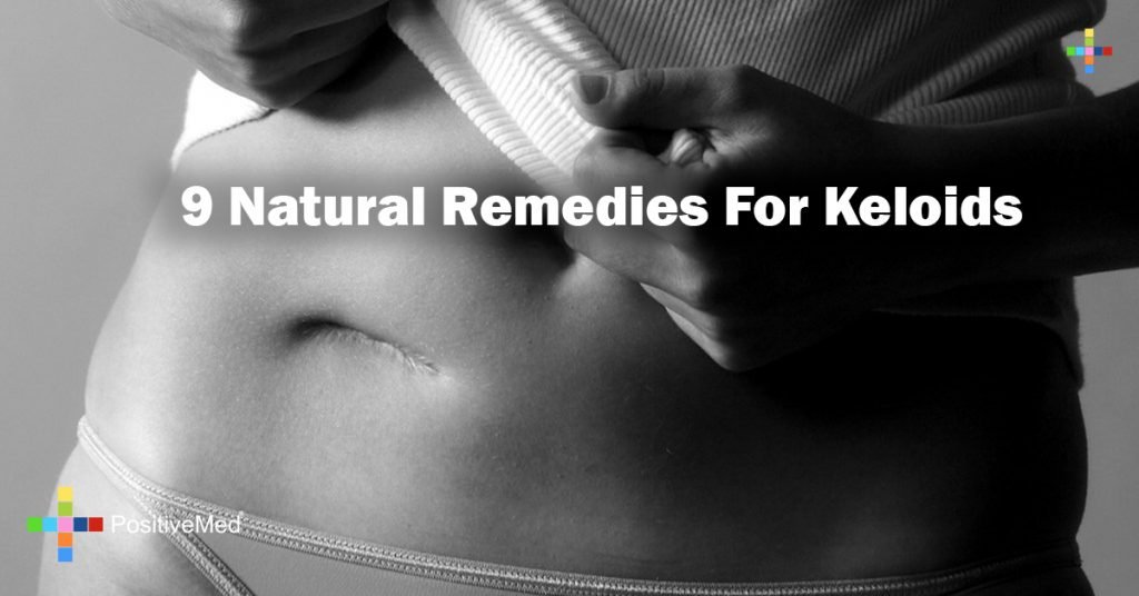 9 Natural Remedies For Keloids 