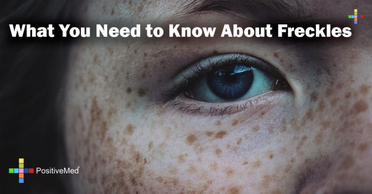 What You Need to Know About Freckles What You Need to Know About Freckles