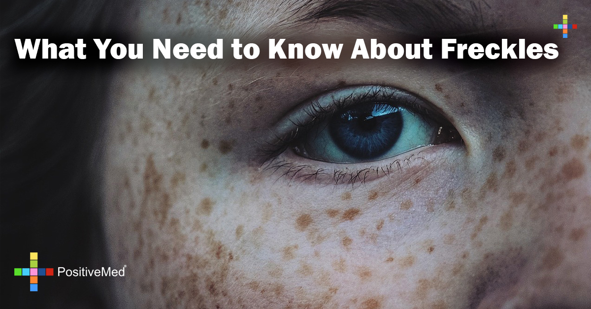 What You Need to Know About Freckles PositiveMed
