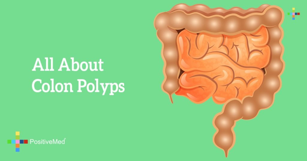All About Colon Polyps