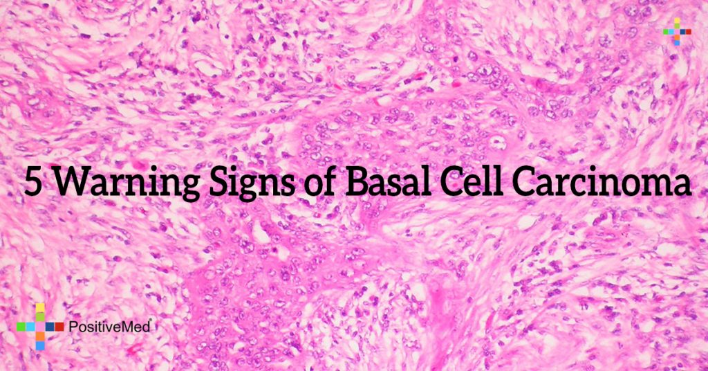 5 Warning Signs of Basal Cell Carcinoma
