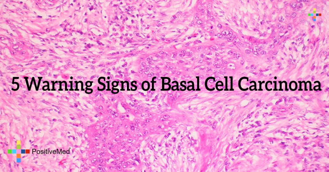 5 Warning Signs of Basal Cell Carcinoma PositiveMed