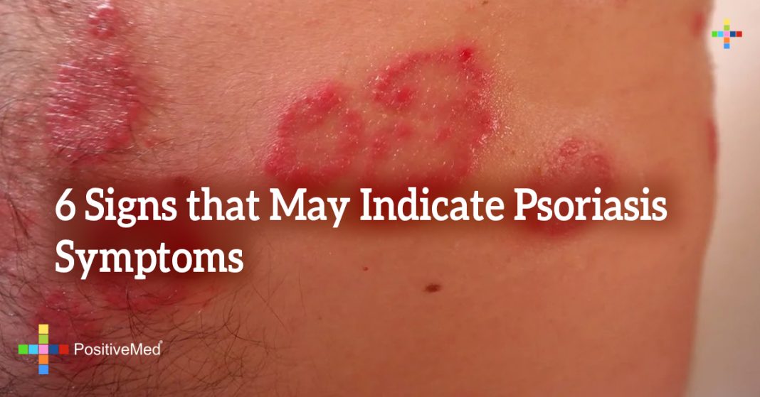 6 Signs that May Indicate Psoriasis Symptoms PositiveMed