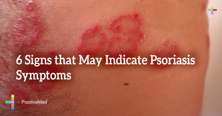 6 Signs that May Indicate Psoriasis Symptoms