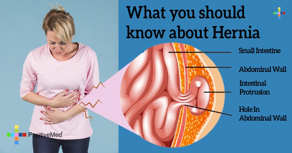 What you should know about Hernia