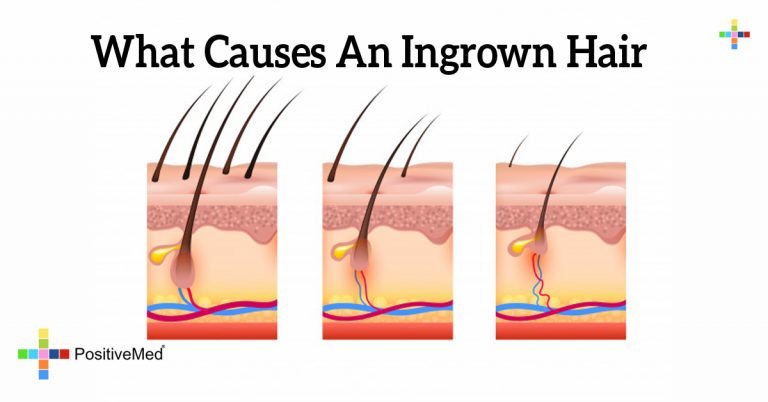 What Causes An Ingrown Hair