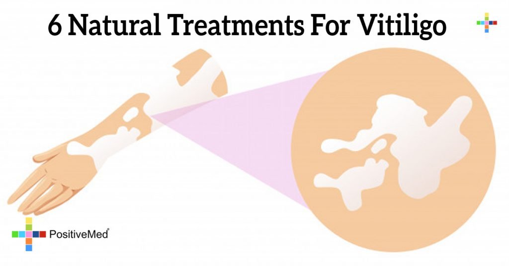 6 Natural Treatments For Vitiligo