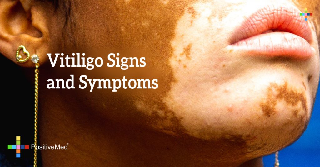 Vitiligo Signs and Symptoms