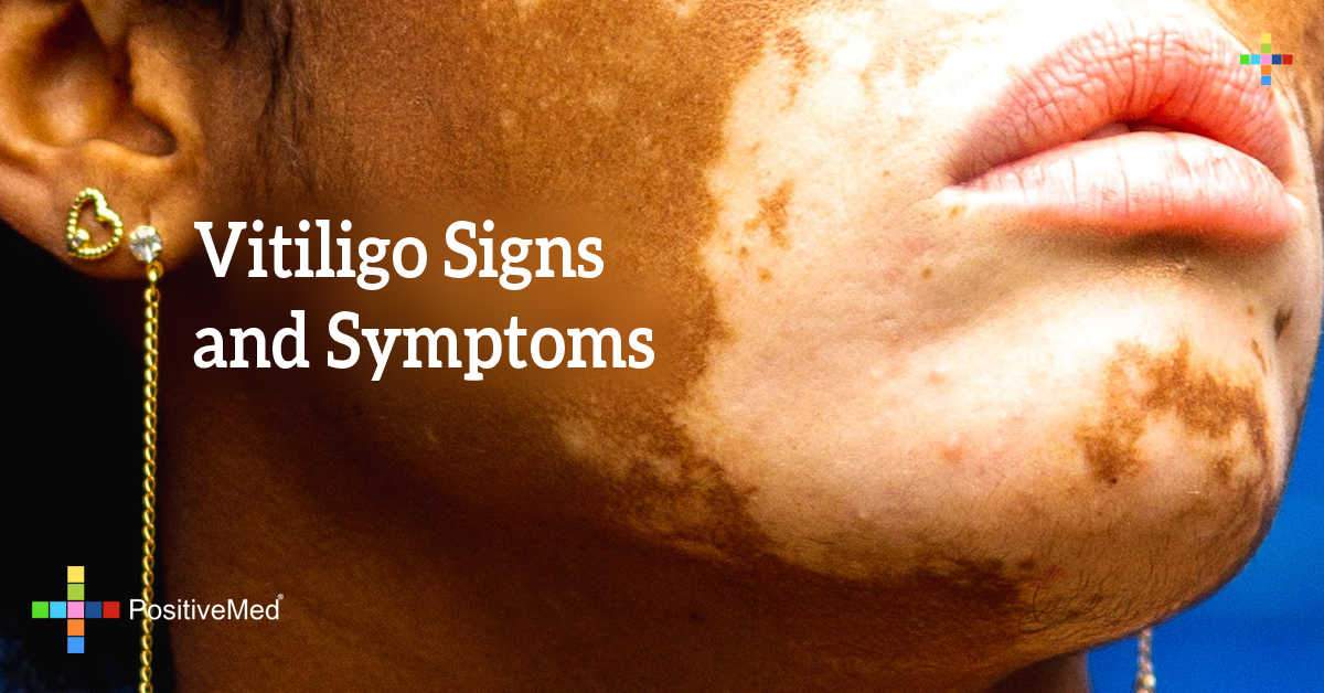 Vitiligo Signs and Symptoms