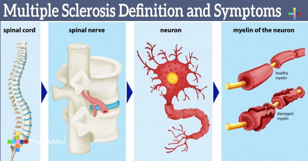 Multiple Sclerosis Definition and Symptoms
