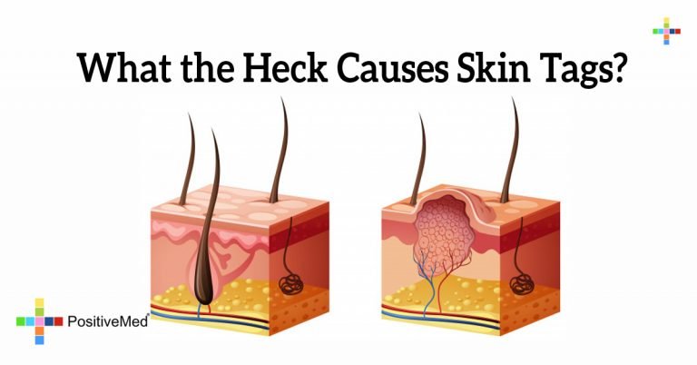 What the Heck Causes Skin Tags?