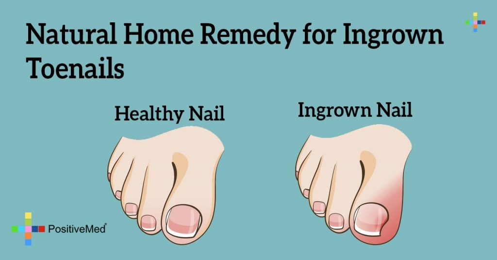Natural Home Remedy for Ingrown Toenails