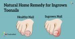 Natural-Home-Remedy-for-Ingrown-Toenails-1