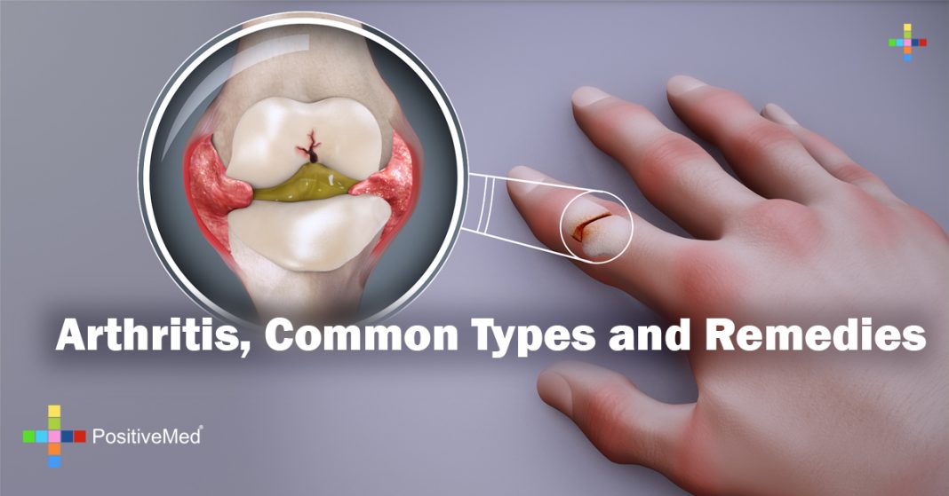 Arthritis, Common Types and Remedies