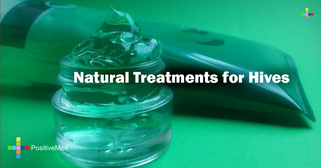 Natural Treatments for Hives