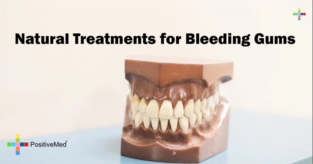 8 Natural Treatments for Bleeding Gums