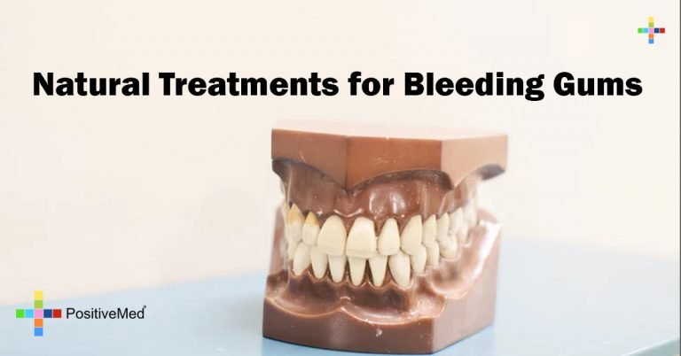 8 Natural Treatments for Bleeding Gums 8 Natural Treatments for Bleeding Gums