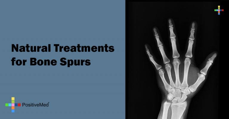 Natural Treatments for Bone Spurs