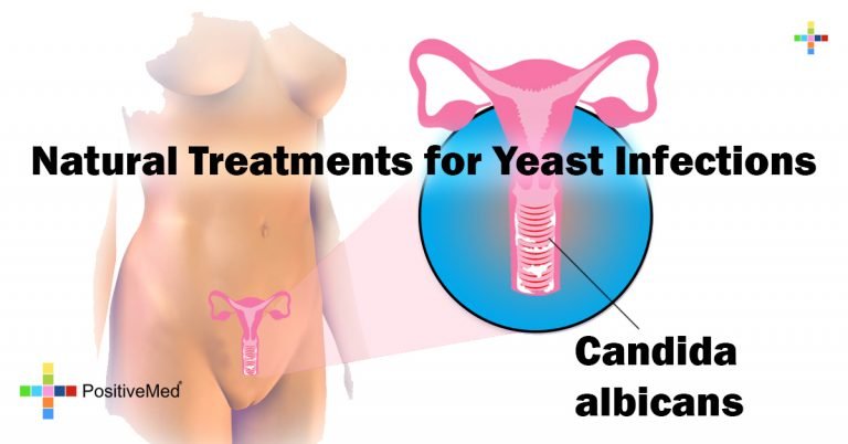 Natural Treatments for Yeast Infections