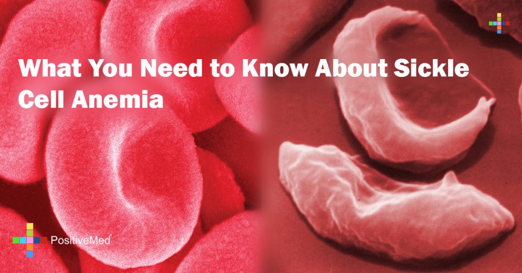 What You Need to Know About Sickle Cell Anemia