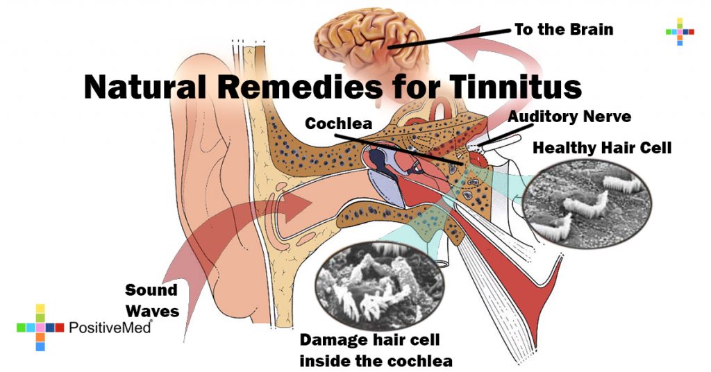 Natural Remedies for Tinnitus