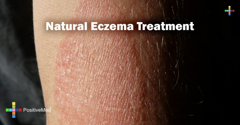 Natural Eczema Treatment Natural Eczema Treatment