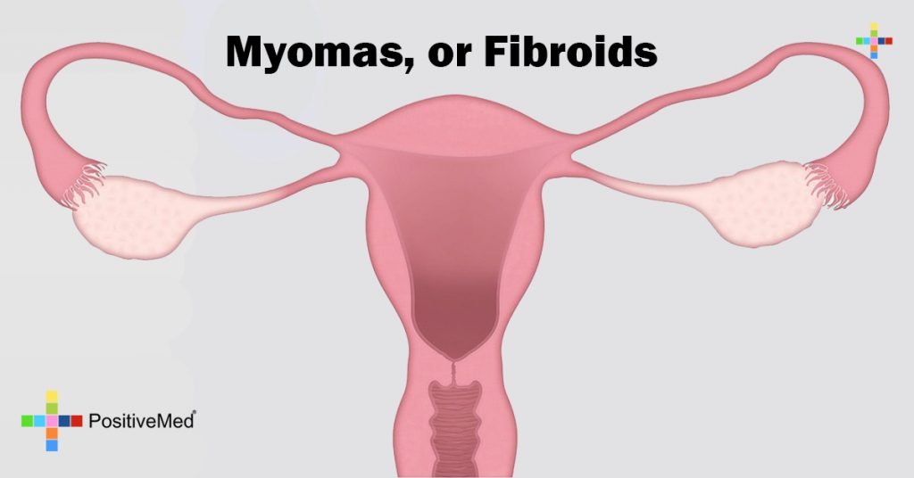 Myomas, or Fibroids