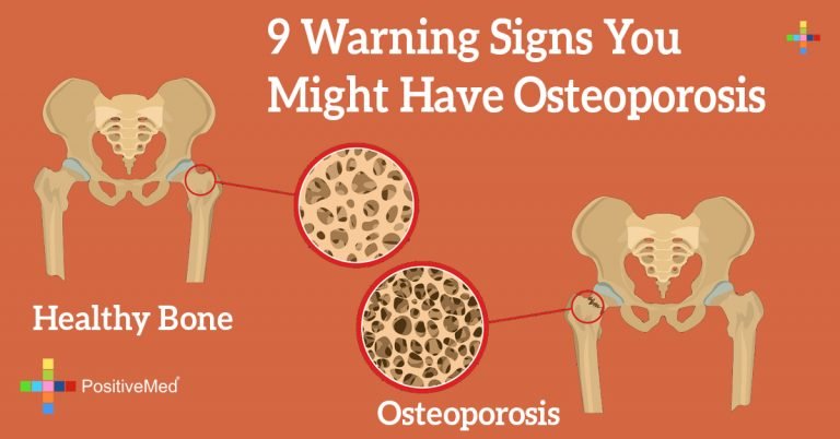 9 Warning Signs You Might Have Osteoporosis