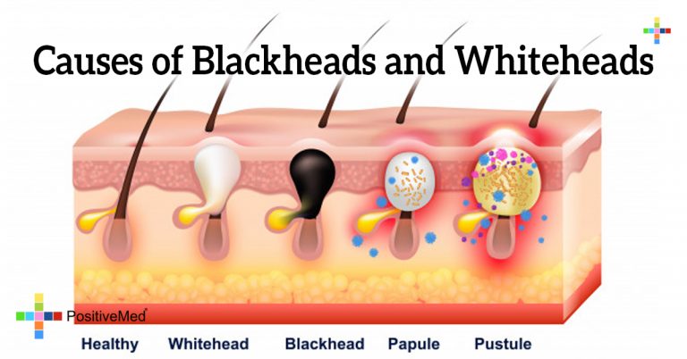 Causes of Blackheads and Whiteheads