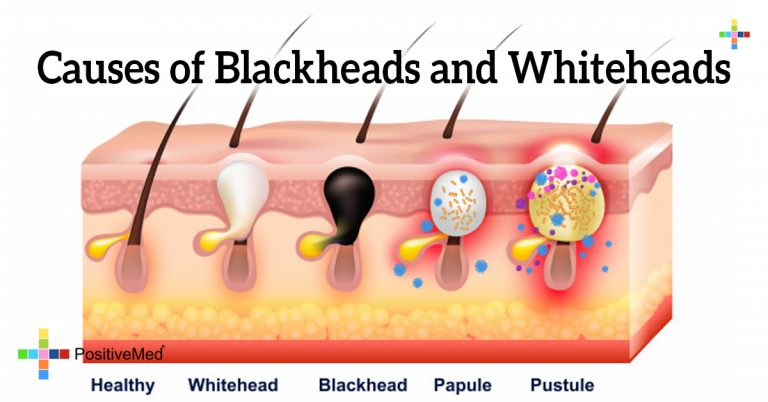 Causes of Blackheads and Whiteheads Causes of Blackheads and Whiteheads